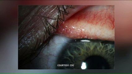 'I Felt One Squiggle': Woman Pulls More Than a Dozen Worms from Her Eye