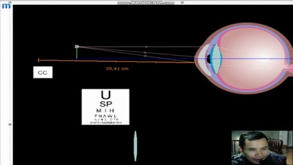 Mắt lão, tật viễn thị, cách khắc phục tật viễn thị bằng kính