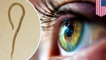 14 worms pulled from Oregon woman's eye