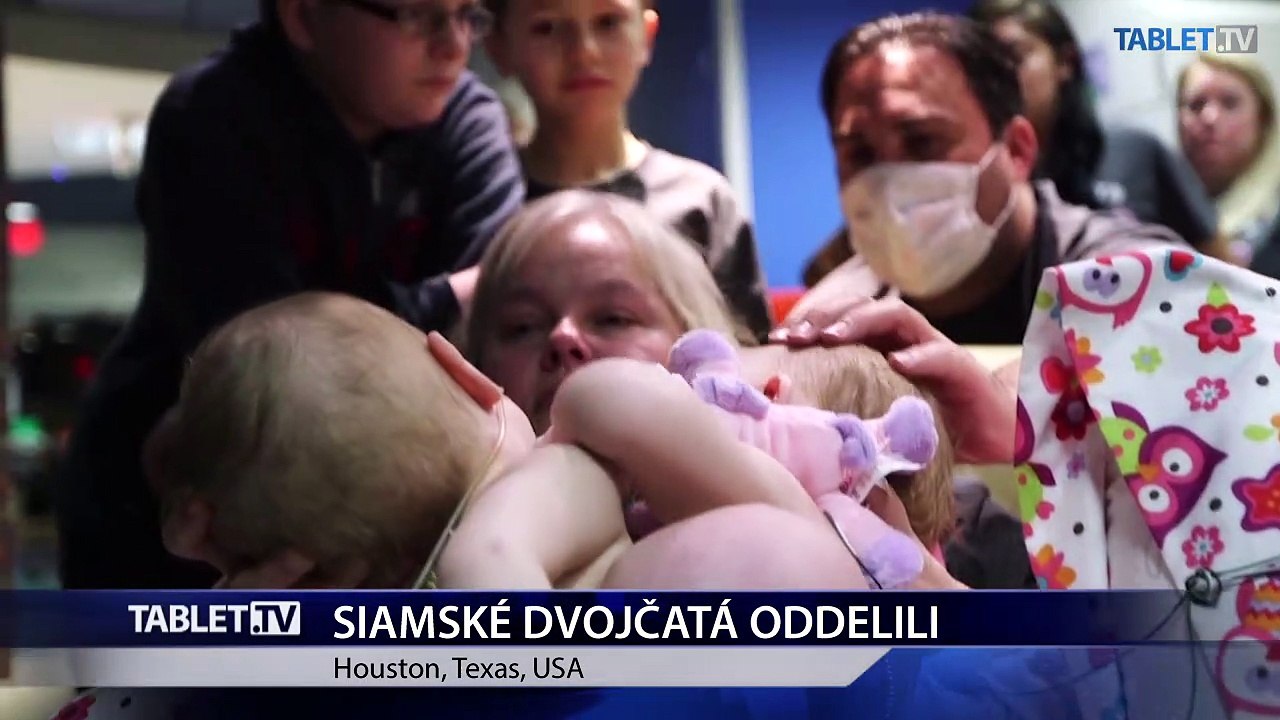 V Houstone oddelili siamské dvojčatá zrastené hruďami a bruškami