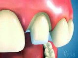 Chirurgie ethetique tunisie - opération de fixation prothèses dentaires