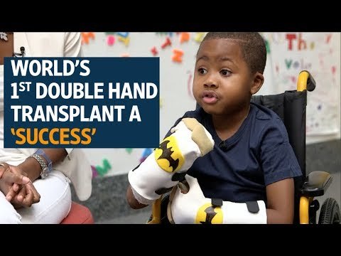 World’s 1st double hand transplant a success