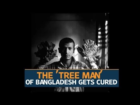 Bangladesh 'Tree Man' gets to go home after recovery from surgery