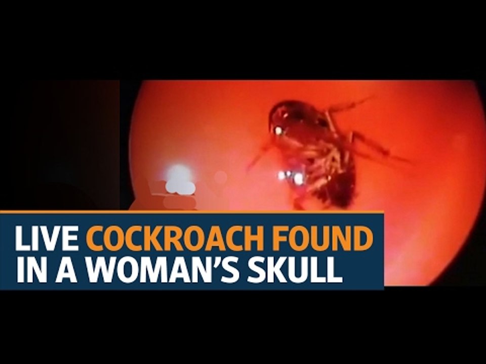 Doctor pulls out live cockroach from a woman's skull in Chennai
