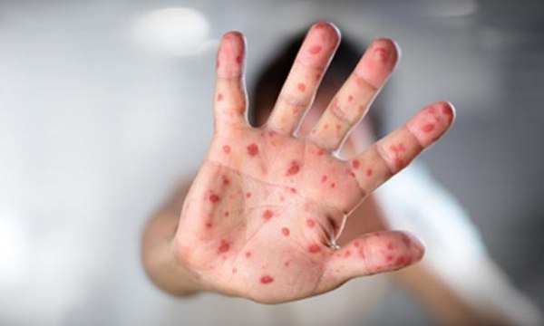 Puluhan Warga Mamasa, Sulawesi Barat, Terserang Campak