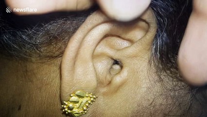 Living spider removed from ear of woman