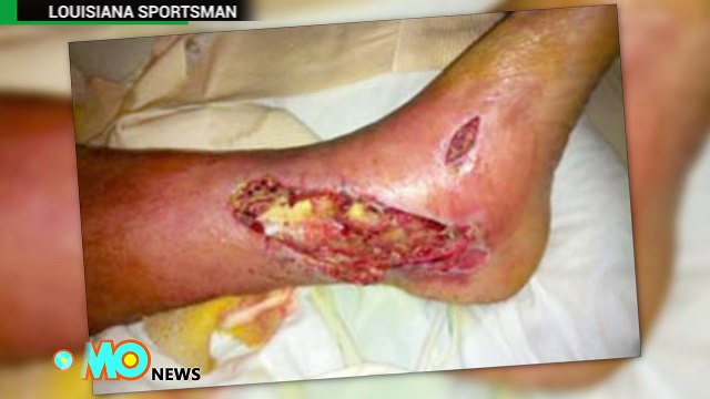 Ce qu'il faut savoir sur la bactérie mangeuse de chair pour éviter d'être infecté