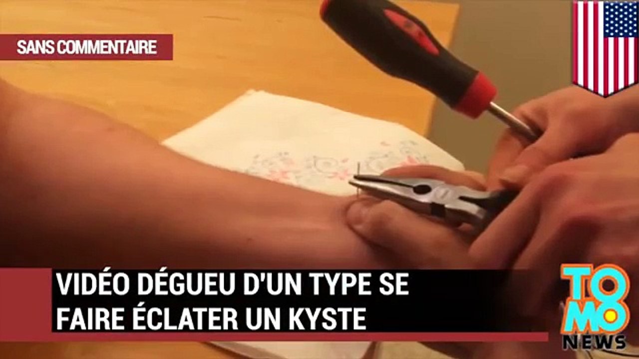 Regardez cette vidéo dégueu d’un type se faire éclater un kyste