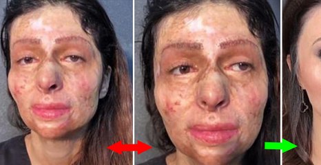 Une jeune femme défigurée dans un incendie est aujourd’hui totalement transformée !