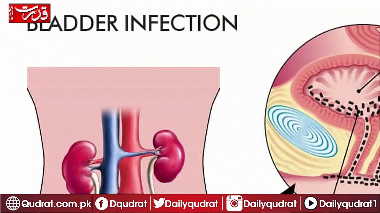 benign-prostatic-hyperplasia-bph-gaytri-manek-formerly-gandotra-md