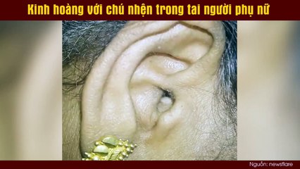 Kinh hoàng với chú nhện trong tai người phụ nữ