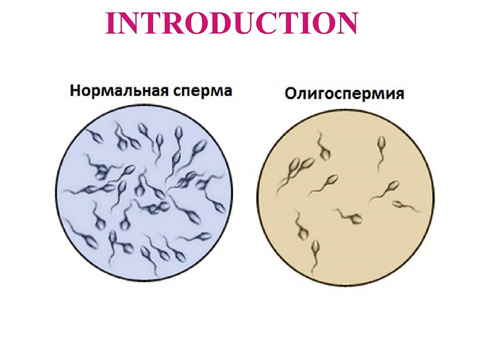 Male infertility: Common causes and treatments