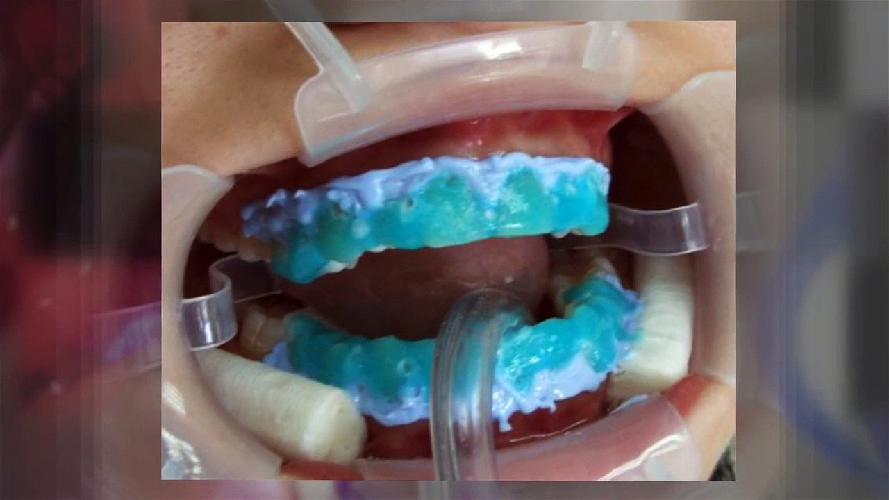 Procedure For Teeth whitening Process in Boca Raton