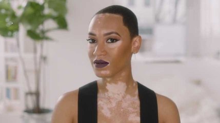 Cette mannequin atteinte de Vitiligo est devenue l'égérie d'une marque de cosmétique