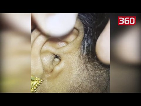 Shkon tek mjeku sepse i dhimbte veshi, ajo që i gjetën brënda i la të gjithë pa fjalë (360video)