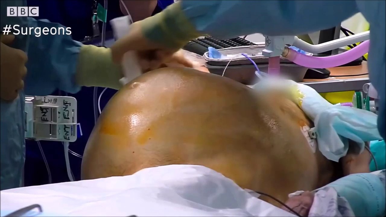 Ces chirurgiens retirent la plus grosse tumeur au cerveau du monde