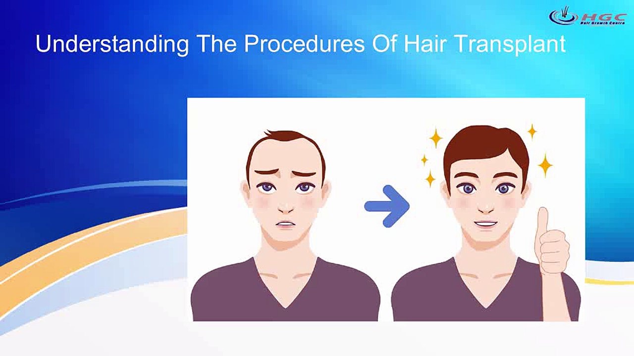 Understanding The Procedures Of Hair Transplant