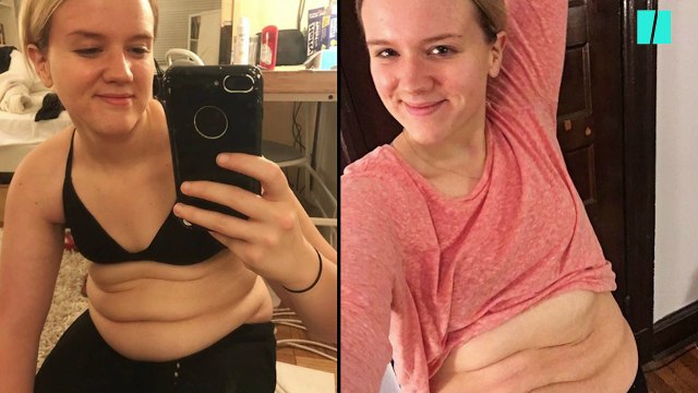 Elle montre les ravages des régimes à répétition sur son corps