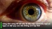 Nếu thấy mắt xuất hiện các triệu chứng bất thường này bạn cần đi khám ngay lập tức