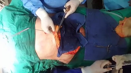 عملية جراحية مباشرة لشد البطن والطبيب مغربي