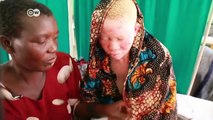 Albinos under threat in Africa | DW News