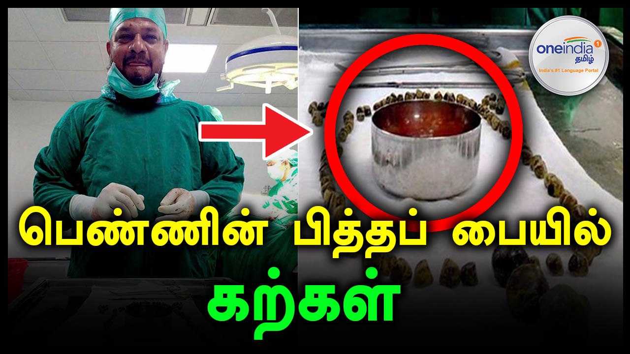 கர்நாடகாவில் பெண்ணின் பித்தப்பையில் இருந்து 99...