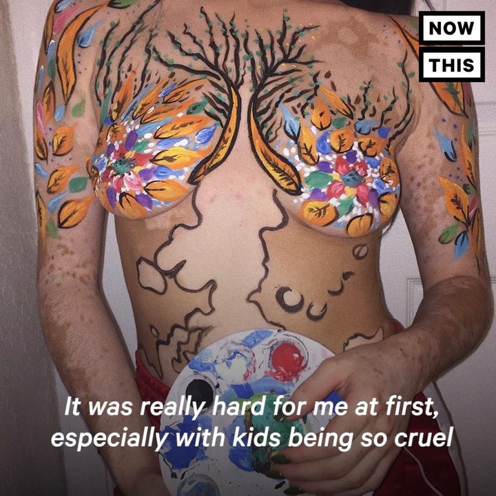 This Girl Transforms Her Rare Skin Condition Into Beautiful Art