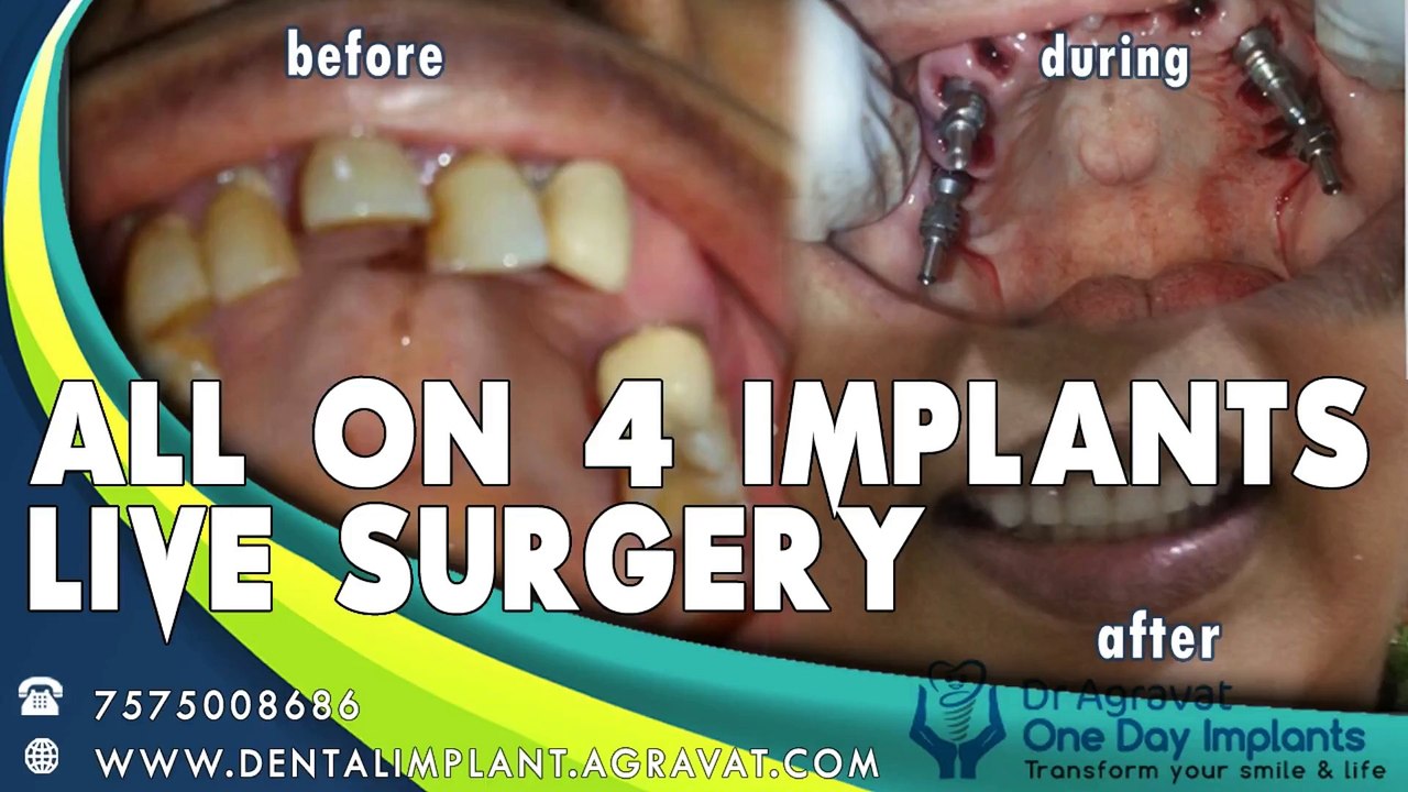 All on 4 Dental Implant Surgery Step by Step Procedure Video Ahmedabad Gujarat India