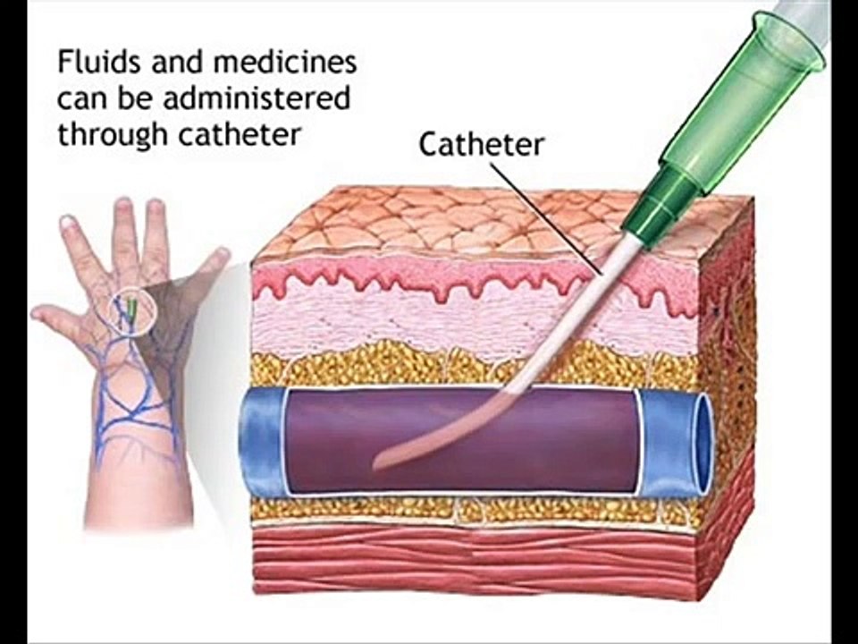 Patient Awareness , Cannula , Intravenous , HEALTH EDUCATION , (ICSP) , URDU / HINDI