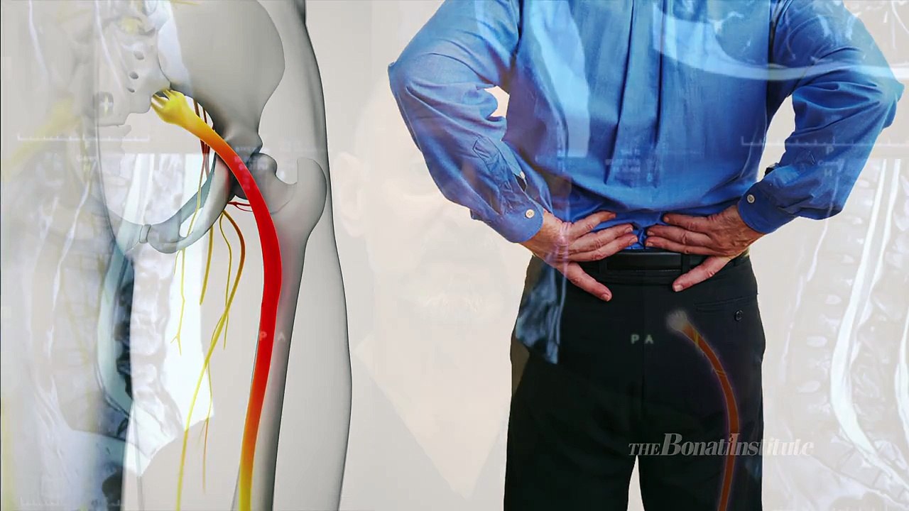 Sciatica Overview