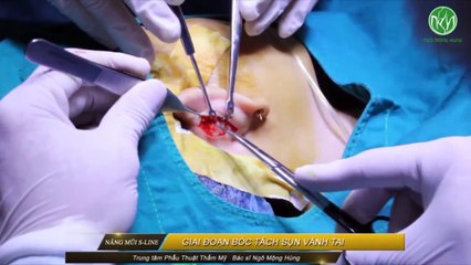 Nâng mũi bao lâu thì lành và ổn định- Bác sĩ tư vấn