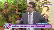 Varis hastalığında tedavi yöntemleri