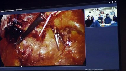 Yozgat'ta ilk kez interaktif katılımla kasık fıtığı ameliyatı yapıldı