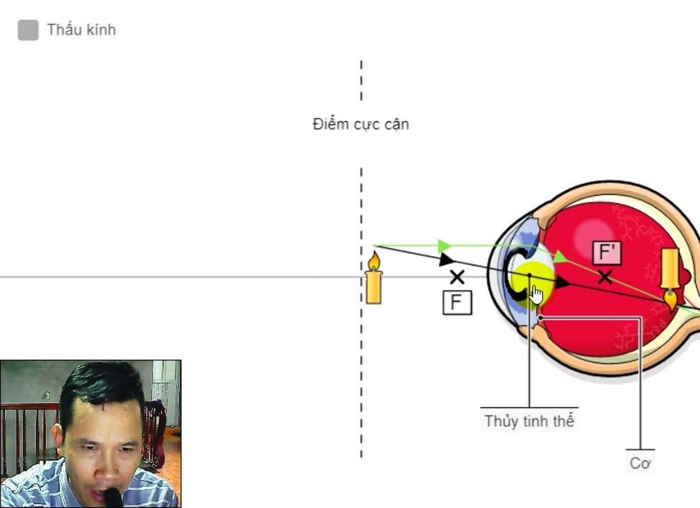 Tật cận thi, biểu hiện, cách khắc phục Y123