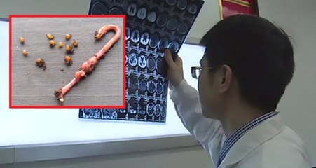 Az Pişmiş Domuz Eti Yiyen Adamın Beyninde 30 Tenya Yumurtası Bulundu
