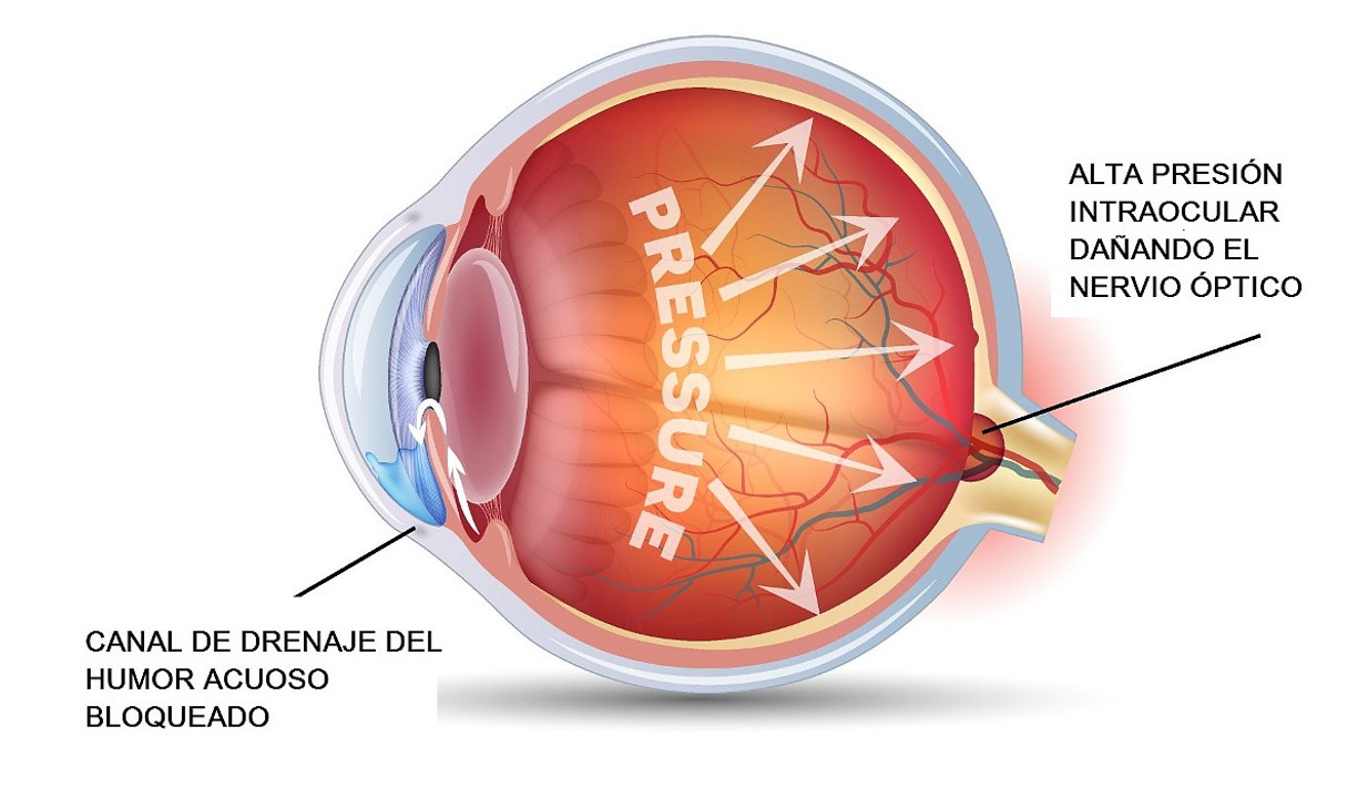 Contra el glaucoma, diagnóstico precoz