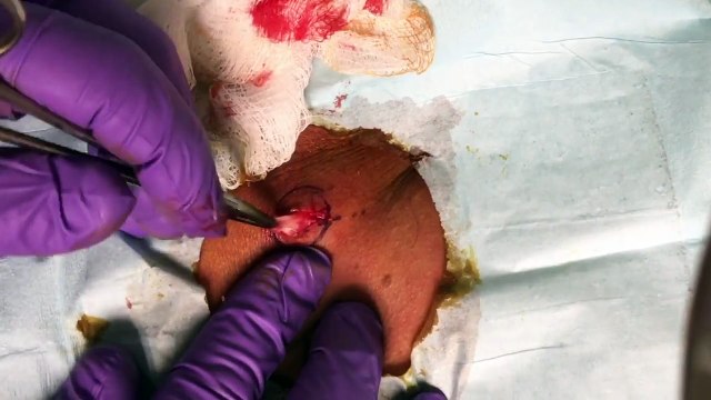 ***GRAPHIC*** TATTOOED SEBACEOUS CYST **POP** SQUEEEZE DR. MICHAEL LEWIS, MD