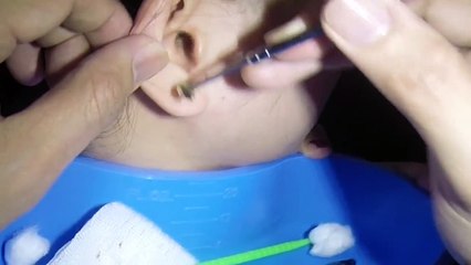 Hardest Granite-like Massive Earwax Removal
