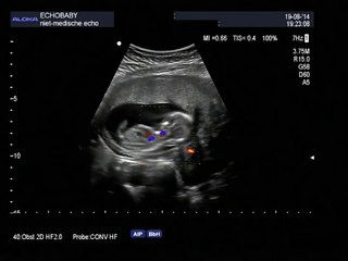 2 en 3D-echo drieling 13 weken zwanger geslachtsbepaling