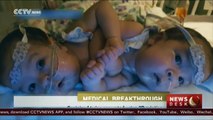 Conjoined twins separated using 3D printing