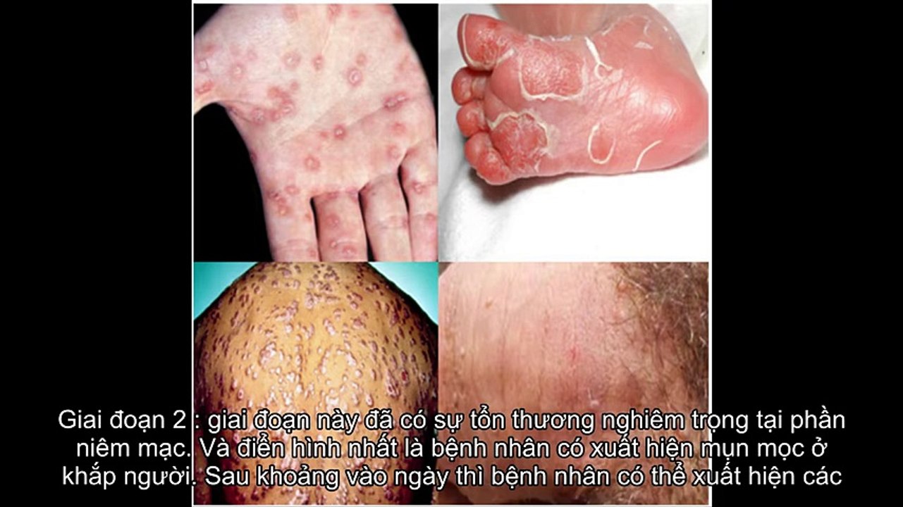 Bệnh giang mai là gì? Triệu chứng và cách điều trị