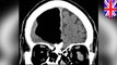 Doctors find large air pocket in old dude's brain