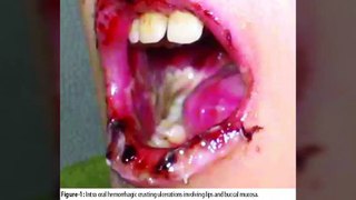 Bệnh mụn rộp sinh dục Herpes Simplex. Bệnh lây qua đường tình dục - YouTube