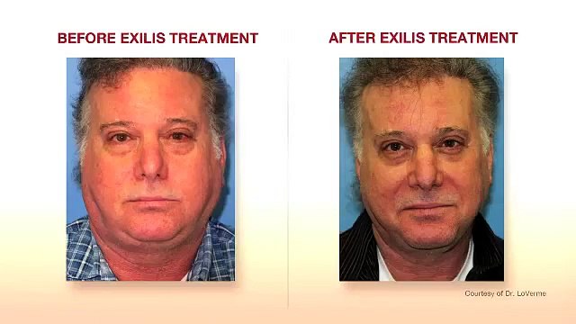 What are the Benefits of Facial Tightening and Contouring?