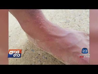 นทท ลงเล่นน้ำทะเลถูกแมงกะพรุนไฟเจ็บ l ตลาดข่าว l 21 ส.ค. 60