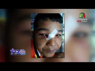 เด็ก ป.6 ถูกพัดลมเพดานเก่าที่ร.ร. ตกใส่ ดั้งหัก จ นครศรีธรรมราช |ข่าวเวิร์คพอยท์| 26 ม.ค. 61