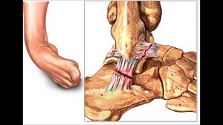 Lateral ankle sprain treatment & rehabilitation exercises video