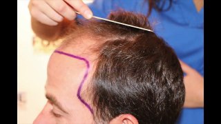 FUE Hair Transplant (3958 grafts in NW-Class lV-A), Dr. Juan Couto - FUEXPERT CLINIC