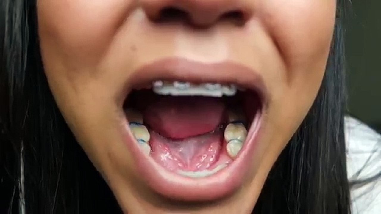 Metal or Ceramic Braces!?! | 1 Month Adult Braces Update