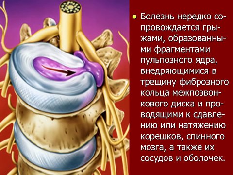 Остеохондроз поясничного отдела позвоночника. Гимнастика при остеохондрозе поясничного отдела